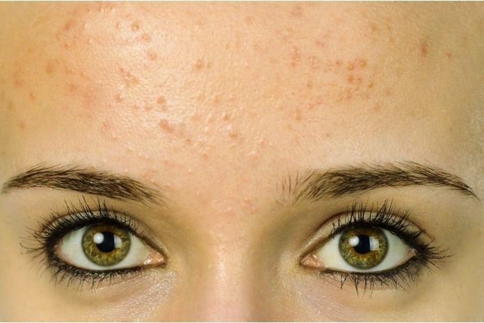 5 Causes Of Forehead Pimples And Tips For Healthy Skin