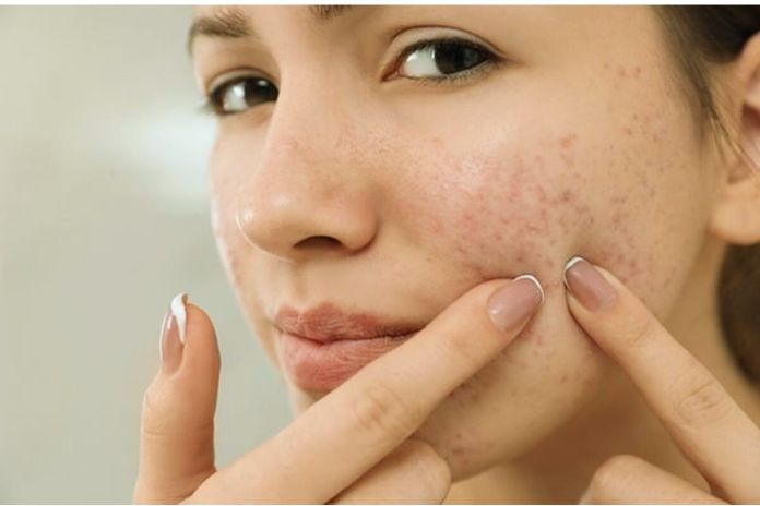 Treatments For Pimples And Blackheads