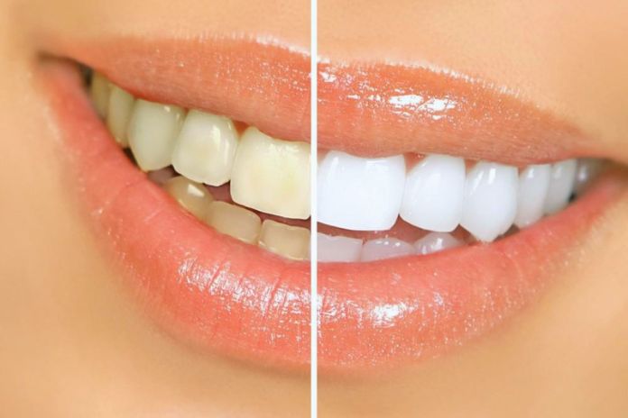Whiten Your Teeth With Natural Methods