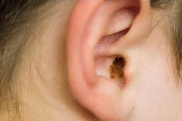 Earwax Plug, Causes, And Remedies