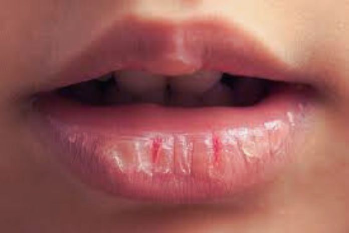 Dry Lips Causes And Tips