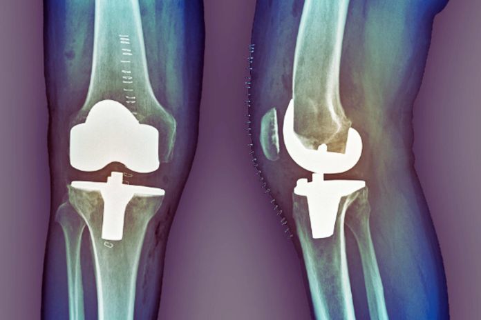 Knee Prosthesis Rehabilitation