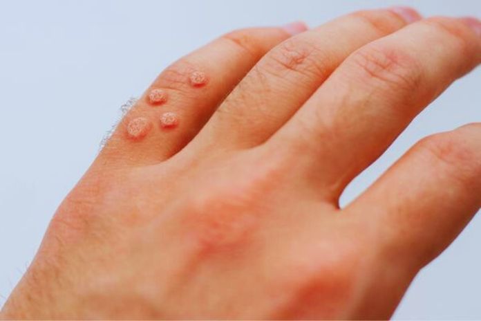 Getting Rid Of Warts Tips And Treatment