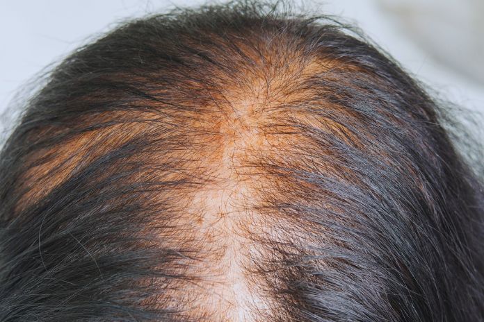 Hair Loss Types, Causes, And Remedies
